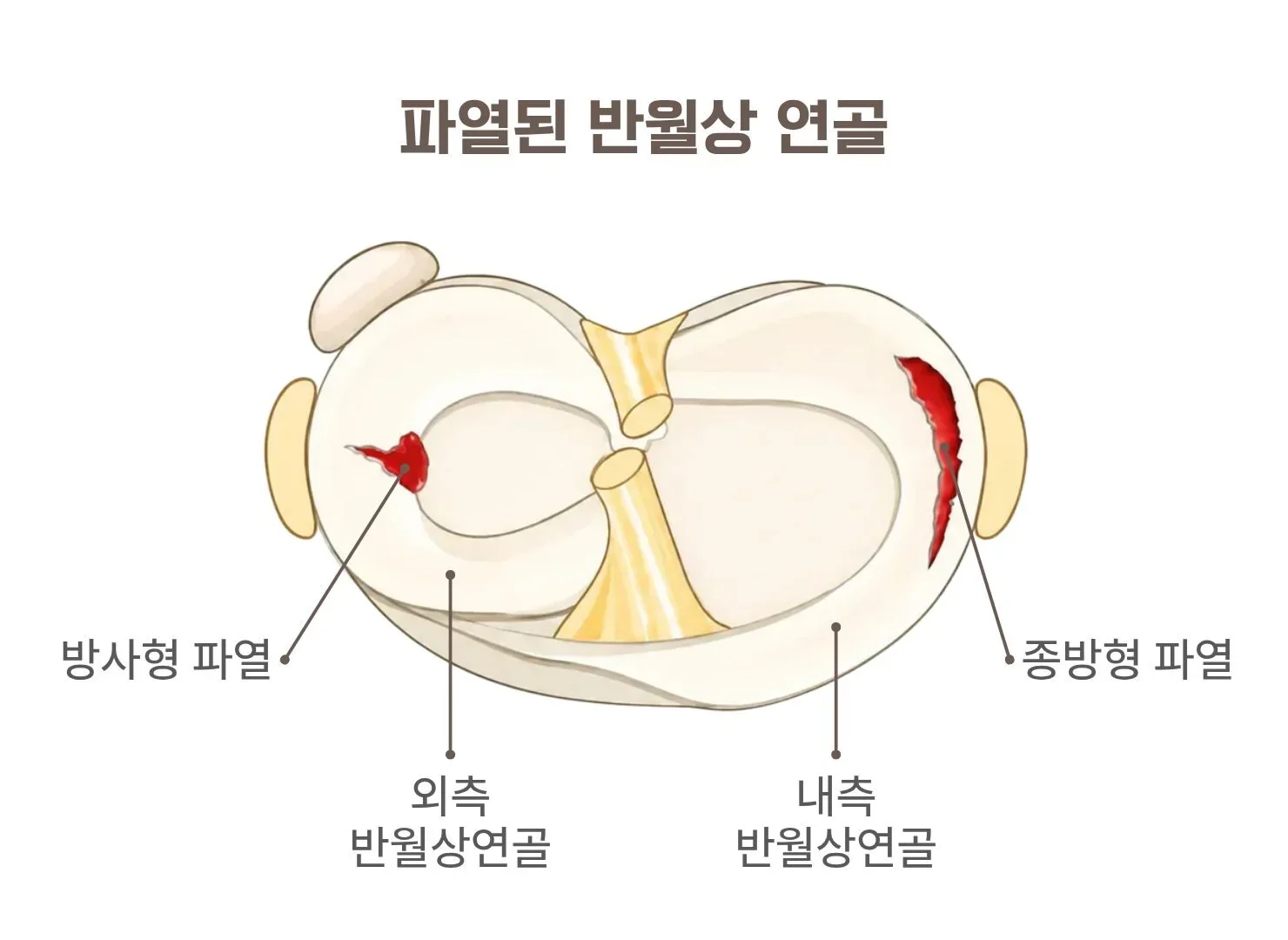 반월상 연골 파열, 수술 안 하면 어떻게 될까요?