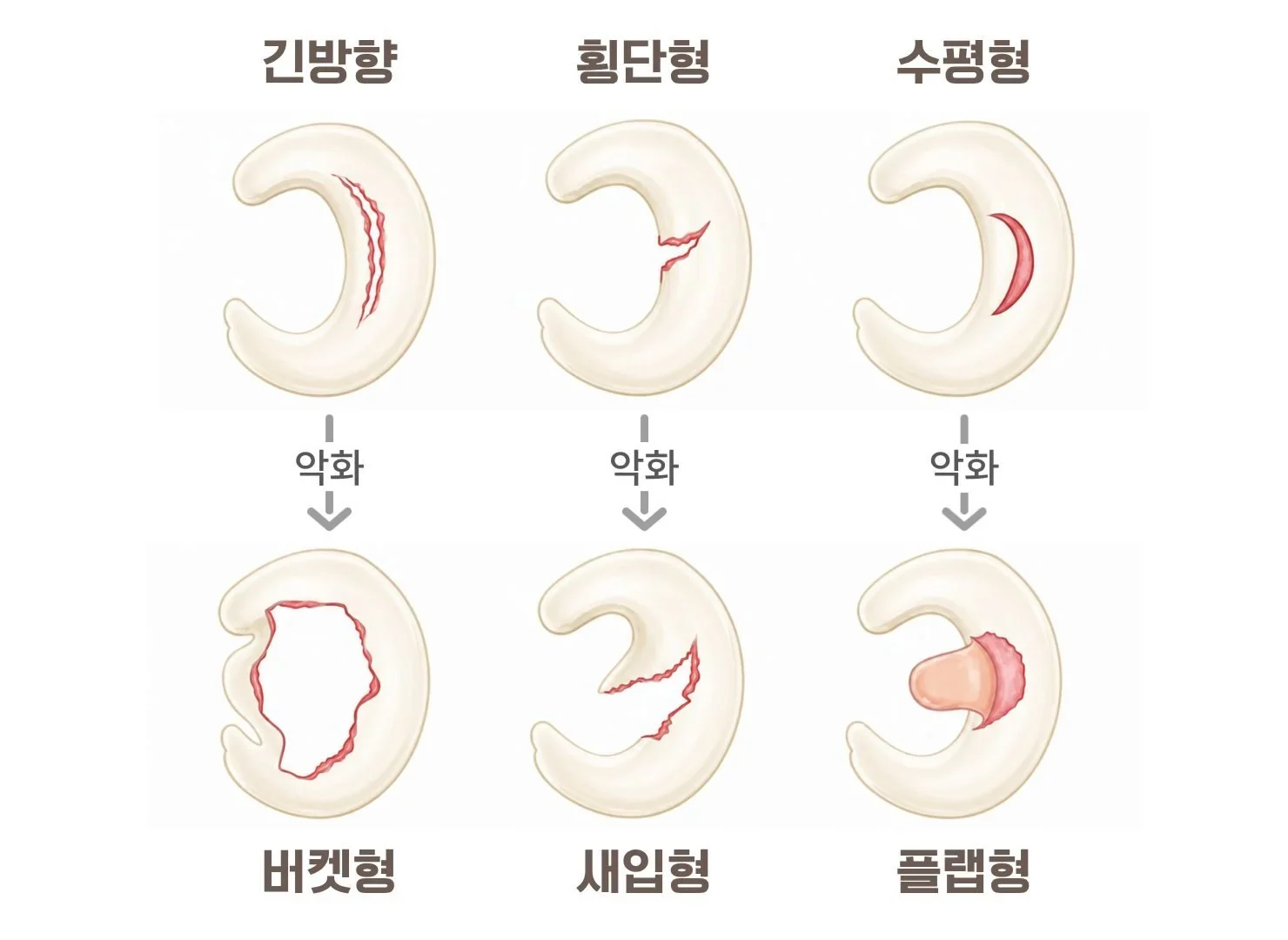 반월상 연골 파열, 수술 안 하면 어떻게 될까요?