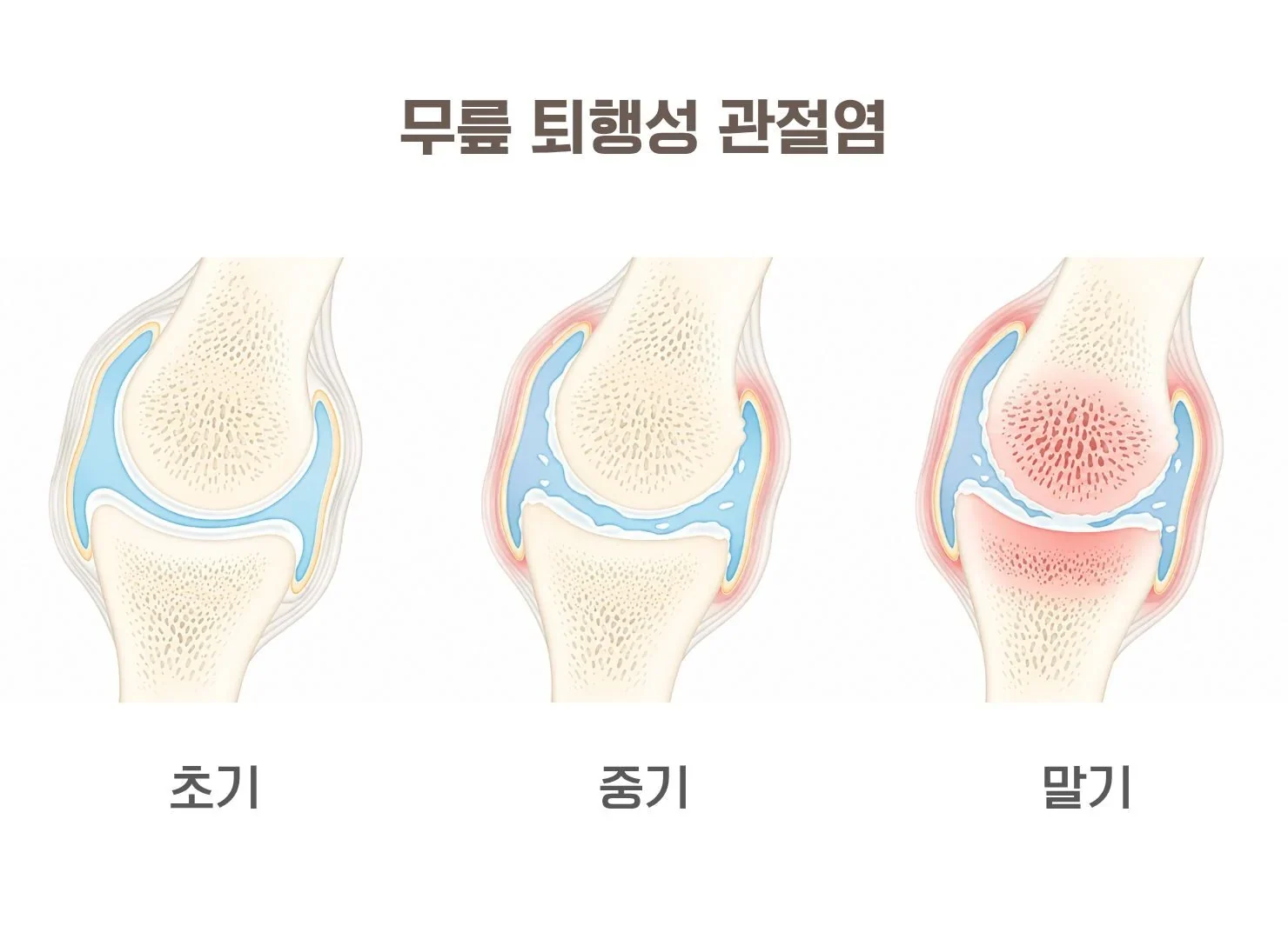 반월상 연골 파열, 수술 안 하면 어떻게 될까요?