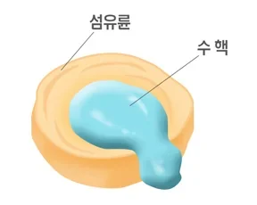 도넛 모양 섬유륜의 틈으로 하늘색 수핵이 밀려 나오는 디스크 삽화
