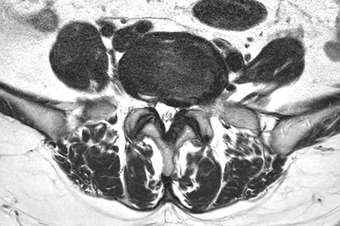 허리 MRI 가로 단면. 척추뼈 뒤쪽으로 튀어나온 디스크가 신경이 지나는 공간을 누르고 있다
