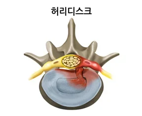 위에서 내려다본 요추 단면. 디스크 일부가 뒤로 밀려 나와 옆의 신경을 붉게 자극하는 모습