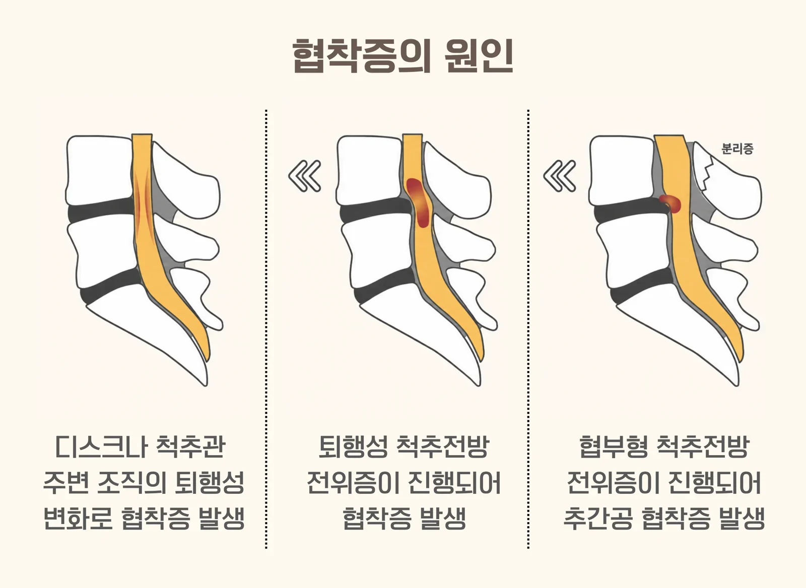 척추관협착증 증상과 자가진단 체크리스트