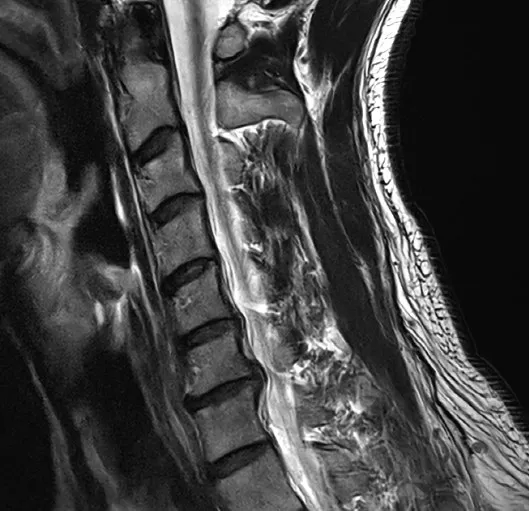 경추 시상면 MRI. 목뼈 사이의 디스크가 뒤로 밀려 나와 척수와 신경이 지나는 앞쪽 공간이 좁아져 있다.