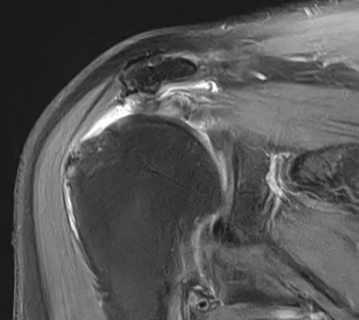 회전근개파열 MRI 소견. 끊어진 힘줄이 원래 붙어 있던 자리에서 안쪽으로 말려 들어가 있다.