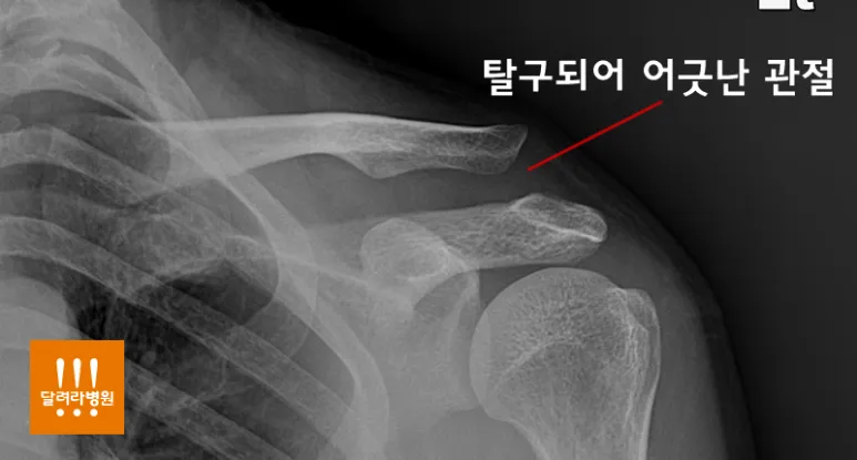 견봉쇄골 관절 탈구 X-ray. 쇄골 바깥쪽 끝이 위로 올라가 계단처럼 어긋난 모습