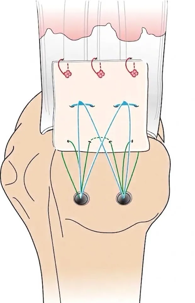 ADM 패치 고정을 마친 모습의 모식도. 패치가 힘줄 끝과 뼈의 부착부를 함께 덮고 있으며, 앵커 두 개에서 나온 실이 X자로 교차해 패치를 눌러 고정하고 있다