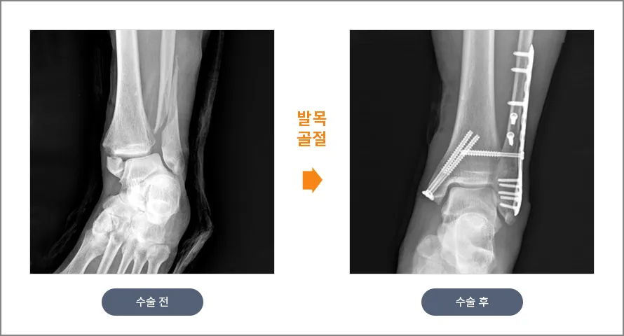 발목 골절 수술 전후 X-ray