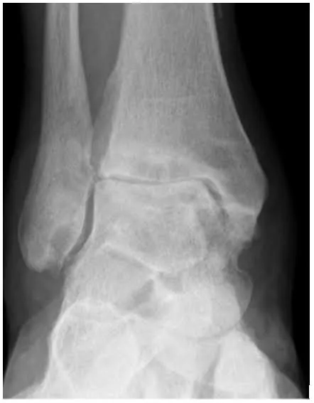 발목 관절염 X-ray. 발목 관절 간격이 좁아지고 관절면이 불규칙해진 모습이 보인다