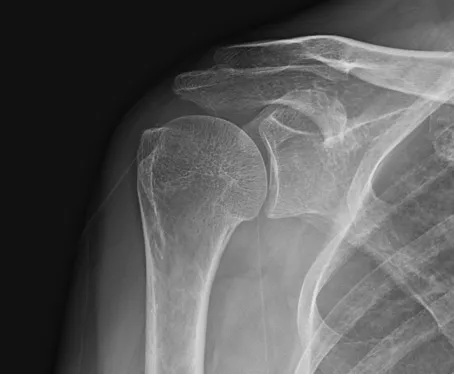 석회성건염에서 초음파 유도 주사와 체외충격파 치료 경과 중 촬영한 X-ray