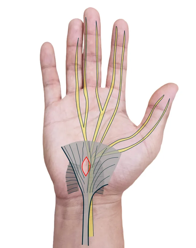 손목 터널 절개술(carpal tunnel release) 모식도. 손목 통로를 덮은 가로손목인대(빨간 선)를 절개해 눌린 정중신경의 압박을 푸는 부위를 보여준다