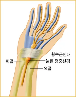 손목터널증후군 모식도. 손목터널 속 정중신경이 눌려 손가락과 손바닥에 저림이 생기는 경로