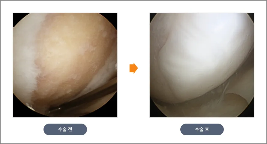 카티스템 시술 전후 무릎 연골 상태를 관절경으로 확인한 사진