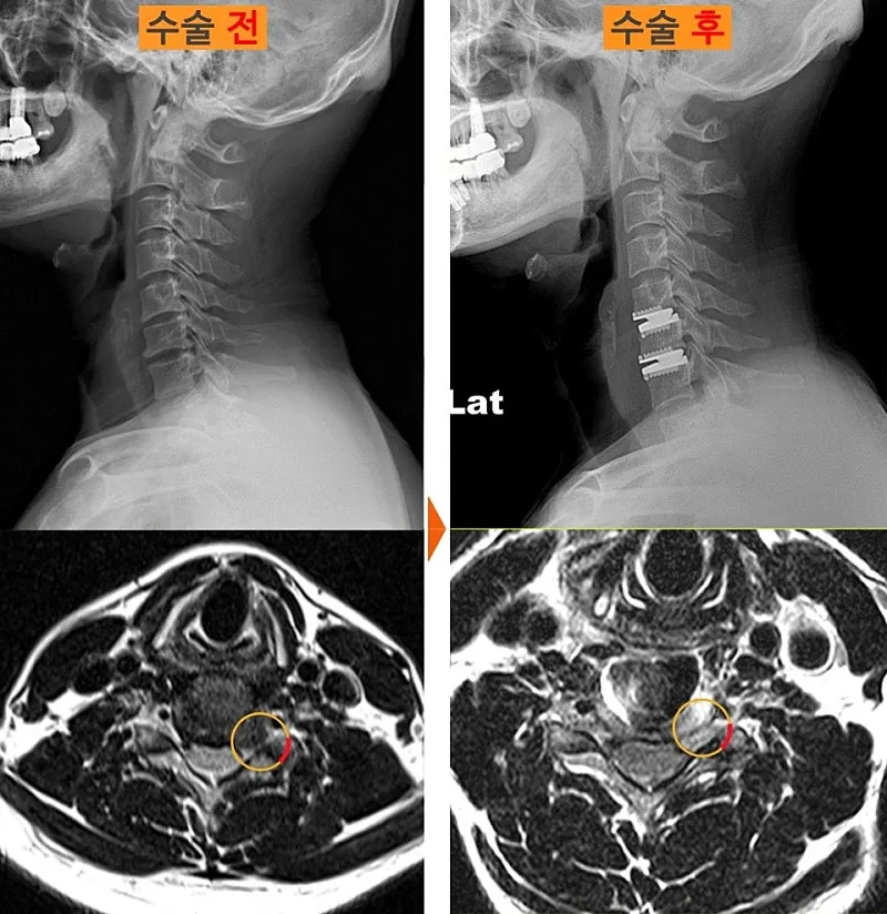 경추 인공디스크 치환술 전후 X-ray와 MRI. 수술 후 두 마디에 인공 디스크가 들어가 있다