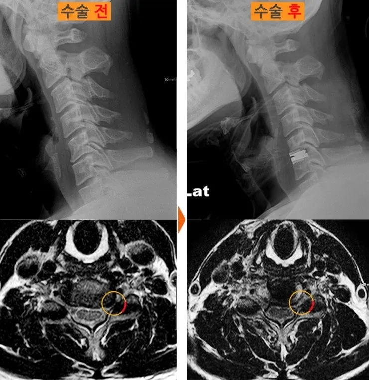 경추 인공디스크 치환술 전후 X-ray와 MRI. 한 마디에 인공 디스크가 들어가 있다