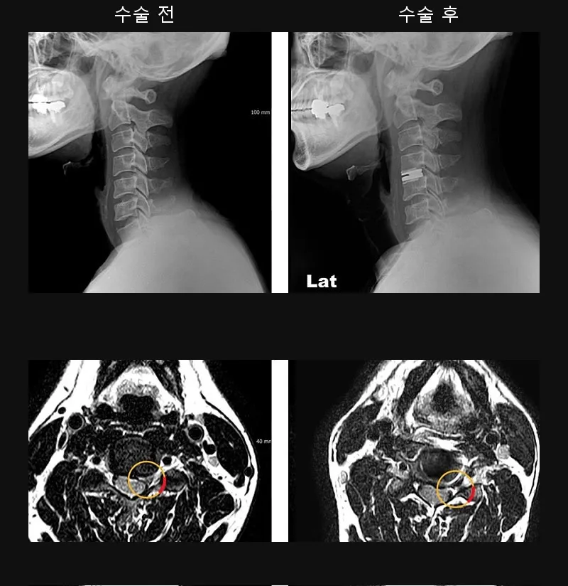 경추 인공디스크 치환술 전후 X-ray와 MRI. 수술 후 신경 통로가 넓어져 있다