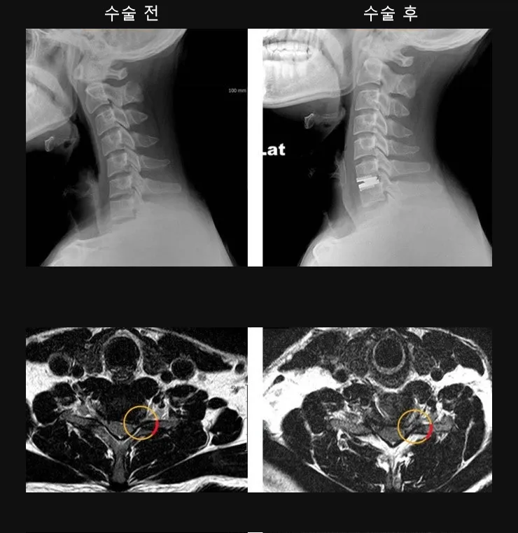경추 인공디스크 치환술 전후 X-ray와 MRI. 눌려 있던 신경 부위가 수술 후 풀려 있다