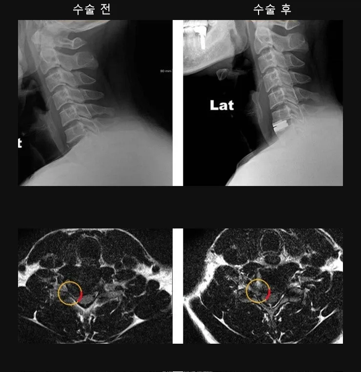경추 인공디스크 치환술 전후 X-ray와 MRI. 수술 후 인공 디스크가 제자리에 있다