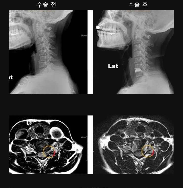 경추 인공디스크 치환술 전후 X-ray와 MRI. 수술 후 좁아졌던 신경 통로가 넓어져 있다