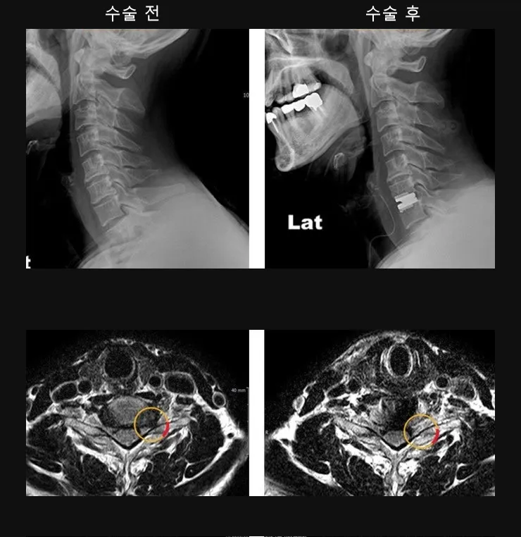 경추 인공디스크 치환술 전후 X-ray와 MRI. 인공 디스크 삽입 후 신경 압박이 풀려 있다