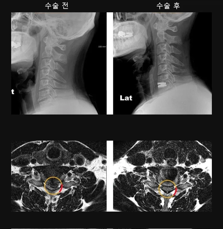 경추 인공디스크 치환술 전후 X-ray와 MRI. 수술 후 인공 디스크가 들어가 신경 공간이 확보되어 있다