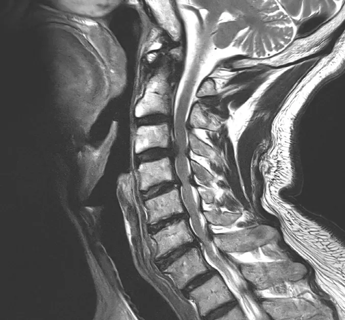경추 디스크 MRI. 튀어나온 디스크가 신경을 누르는 세로 단면