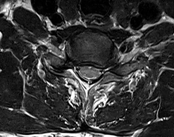 경추 MRI. 양쪽 신경뿌리가 빠져나가는 통로가 좁아진 모습