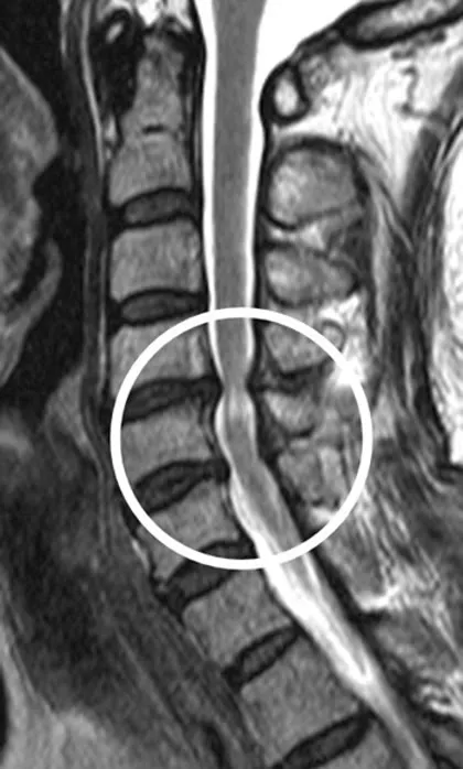 목뼈를 옆에서 본 MRI. 척추뼈 뒤로 지나는 척수가 한 마디에서 눌려 가늘어져 있고, 눌린 부분의 척수가 주변보다 하얗게 보인다