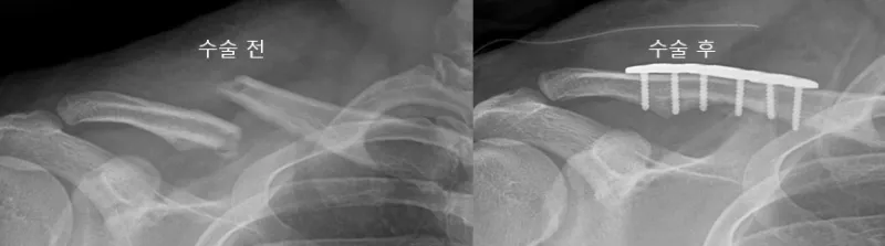 쇄골 골절 잠김 금속판 고정 전후 X-ray 비교