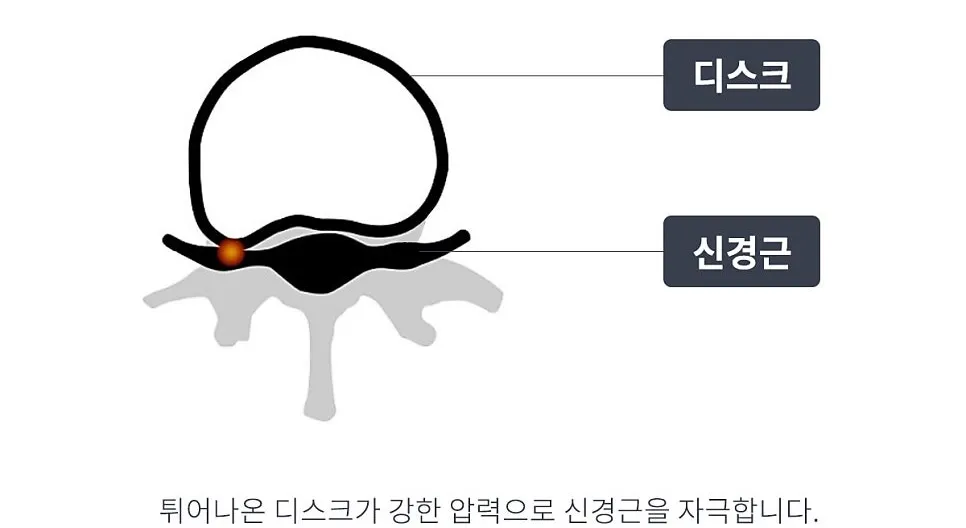 허리디스크에서 신경근이 눌리는 위치를 나타낸 모식도. 뒤로 밀려 나온 디스크가 바로 뒤를 지나는 신경근을 누르고 있다