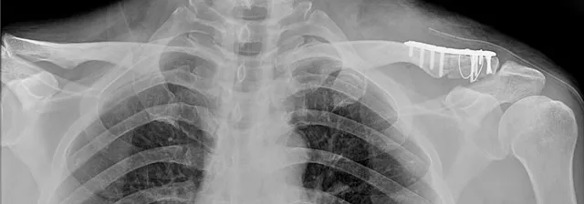 원위(바깥쪽) 쇄골 골절 수술 후 x-ray, 잠김 금속판으로 고정된 모습