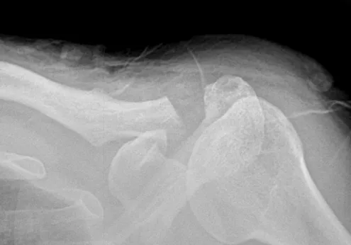 원위쇄골 절제술 후 X-ray. 쇄골 바깥쪽 끝이 약 1cm 다듬어져 견봉과 사이에 공간이 생긴 소견