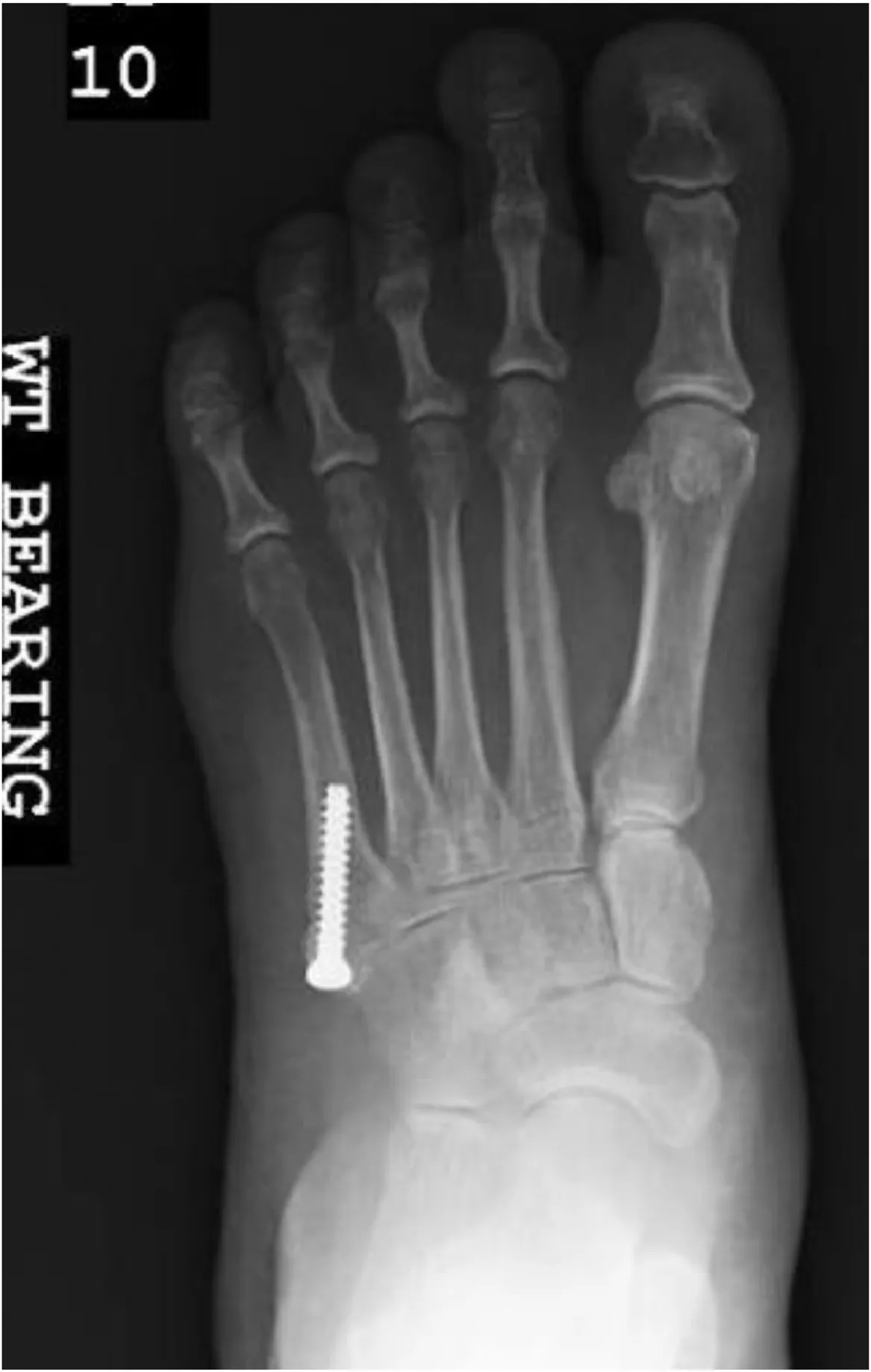 5번 중족골 기저부(존스) 골절을 압박 나사로 골수강 내 고정한 체중 부하 x-ray