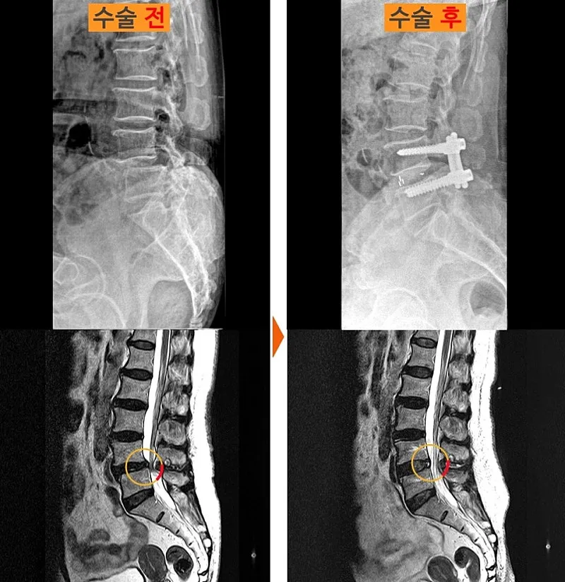 요추 유합술 전후 X-ray와 MRI. 수술 후 나사와 막대로 한 마디가 고정되어 있다
