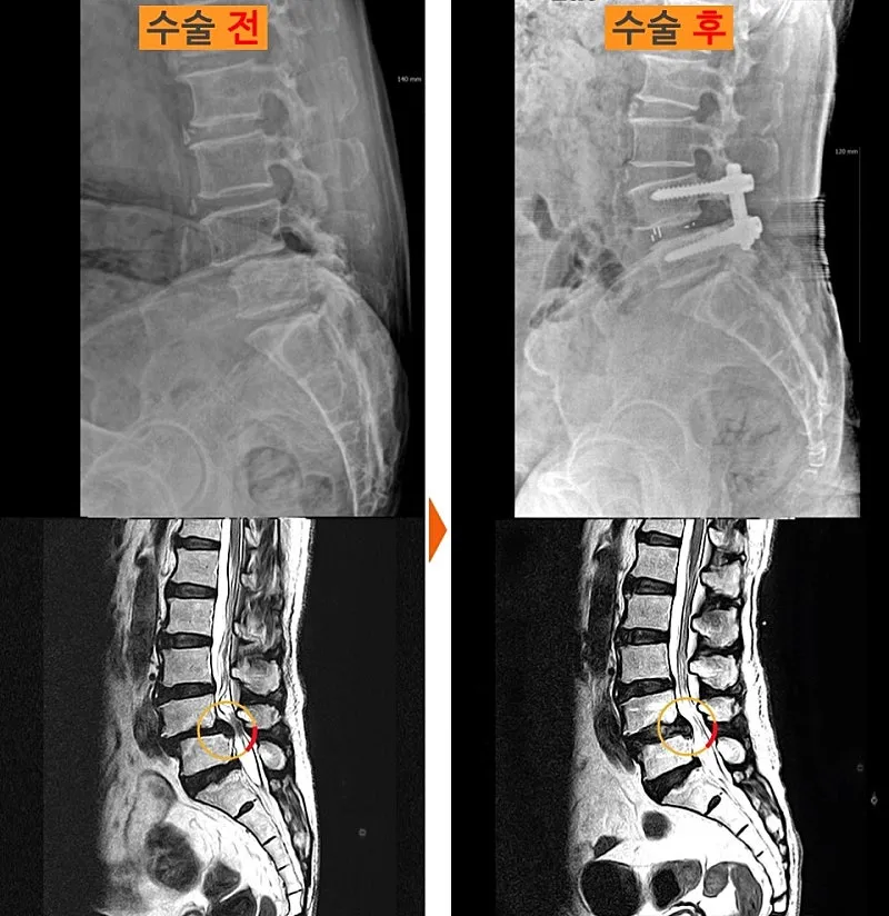 요추 유합술 전후 X-ray와 MRI. 내려앉았던 마디의 높이가 회복되어 있다