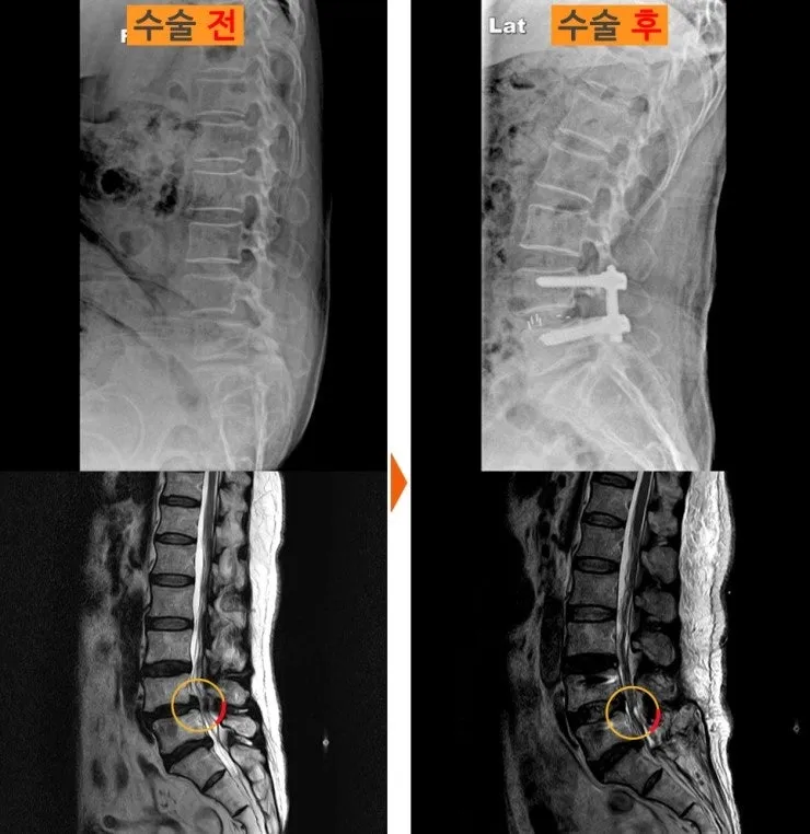 요추 유합술 전후 X-ray와 MRI. 좁아져 있던 신경 통로가 수술 후 넓어져 있다