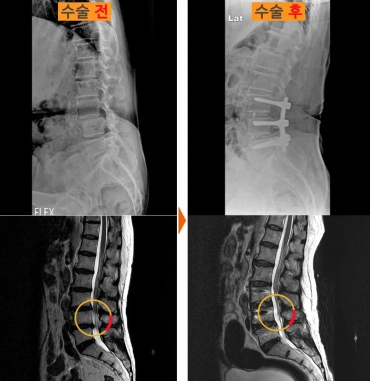 요추 유합술 전후 X-ray와 MRI. 수술 전 굴곡 촬영에서 어긋남이 보이고 수술 후 고정되어 있다