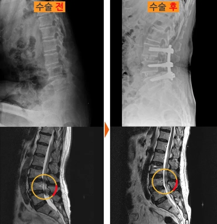 요추 유합술 전후 X-ray와 MRI. 심하게 좁아져 있던 신경 통로가 수술 후 확보되어 있다