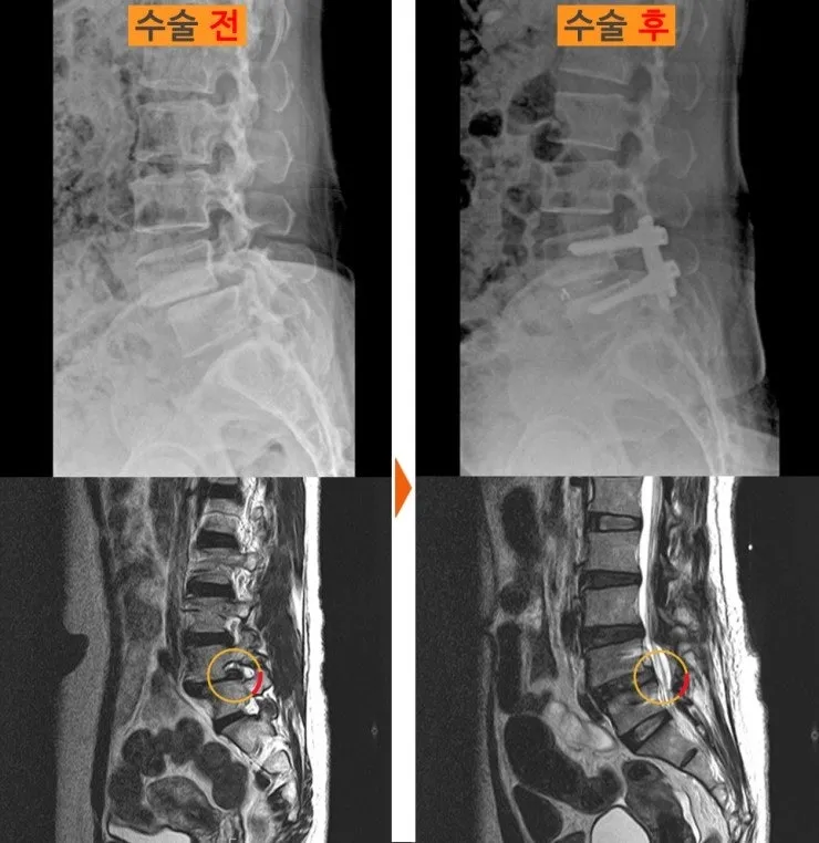요추 유합술 전후 X-ray와 MRI. 계단처럼 어긋나 있던 정렬이 수술 후 맞춰져 있다
