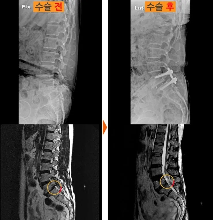 요추 유합술 전후 X-ray와 MRI. 굴곡 촬영에서 확인된 어긋남이 수술 후 교정되어 있다