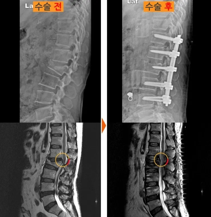 척추 골절에 시행한 유합술 전후 X-ray와 MRI. 여러 마디에 걸쳐 나사와 막대로 고정되어 있다