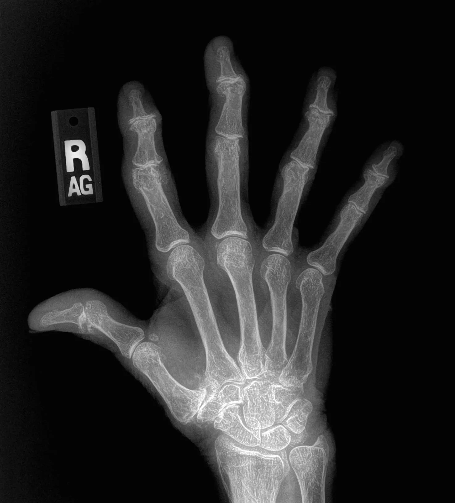 수부 관절염 X-ray. 엄지손가락 뿌리 관절을 포함한 여러 손가락 관절의 간격이 좁아진 모습이 보인다