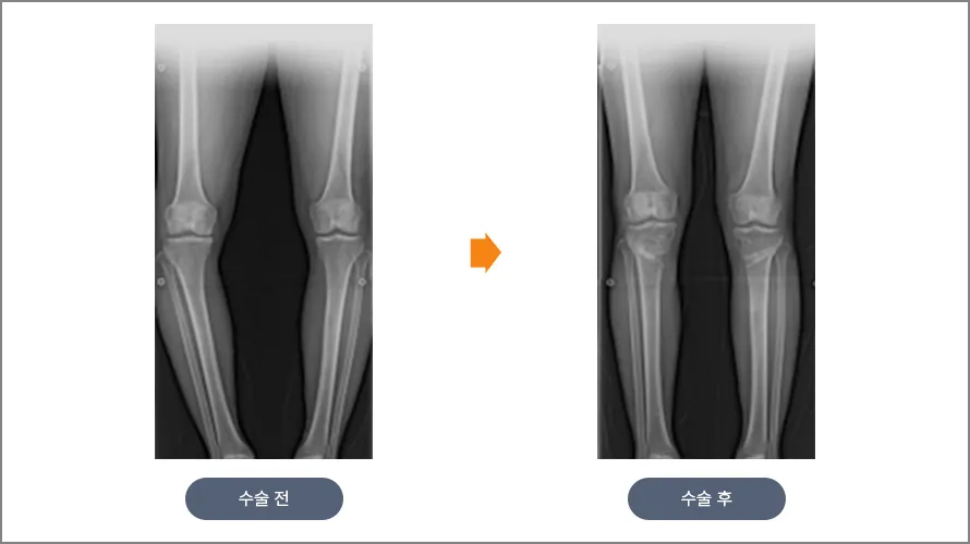 근위경골 절골술 전후 하지 전장 엑스레이 비교. 수술 전에는 양쪽 무릎 사이가 벌어진 O자 다리, 수술 후에는 축이 곧게 선 상태