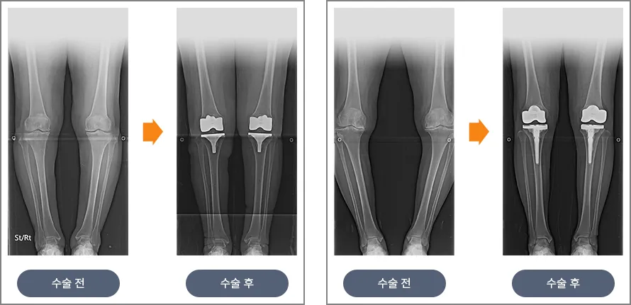 무릎 인공관절 수술 전후 다리 정렬 비교