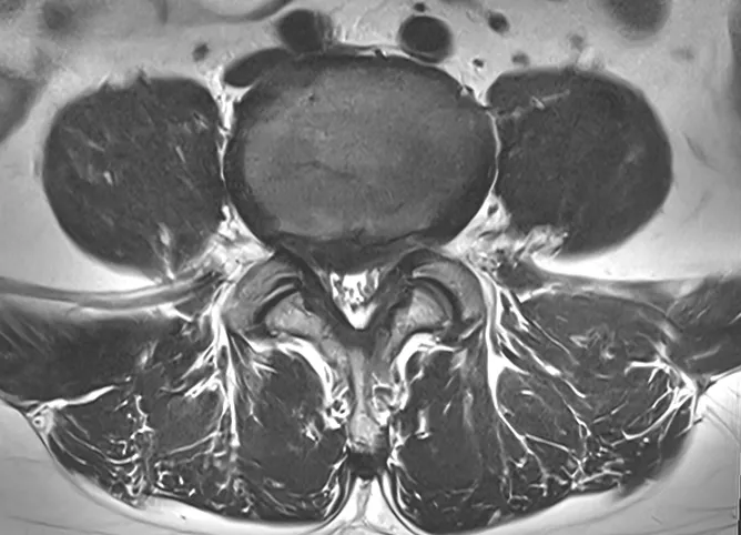 허리 디스크 MRI 가로 단면. 튀어나온 디스크가 신경을 누르는 모습