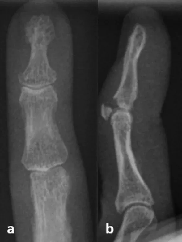 추지 골절 X-ray. 정면(a)과 옆면(b) 사진에서 끝마디 관절 등쪽의 뼈 조각과 관절 어긋남이 보인다