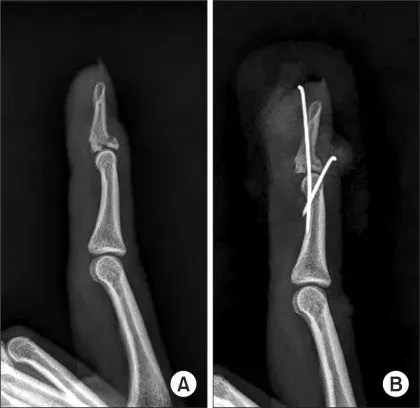 추지 골절을 핀(K-강선) 고정으로 치료한 수술 전후 X-ray. A는 수술 전 뼈 조각과 관절 어긋남, B는 핀으로 고정한 뒤의 모습