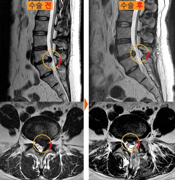 허리디스크 수술 전후 MRI. 위는 세로 단면, 아래는 가로 단면이며 왼쪽 수술 전에 신경을 누르던 디스크가 오른쪽 수술 후에는 제거되어 있다