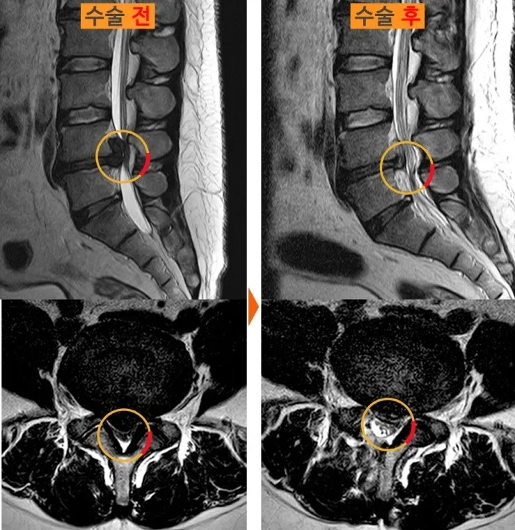 허리디스크 수술 전후 MRI. 신경을 누르던 탈출 디스크가 수술 후 제거된 소견