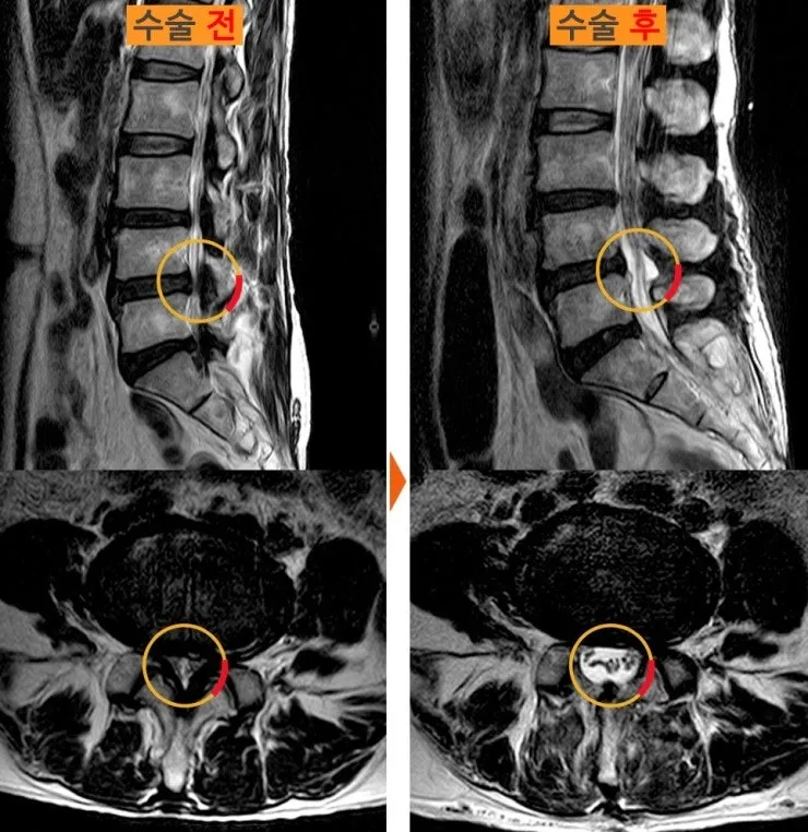 척추관협착증 수술 전후 MRI. 두꺼워진 인대와 뼈로 좁아져 있던 신경 통로가 수술 후 넓어져 있다